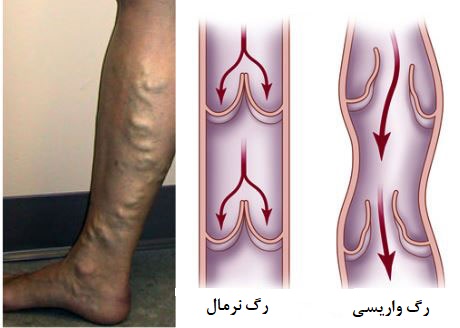 واریس